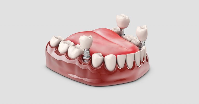 Cirurgia guiada na odontologia