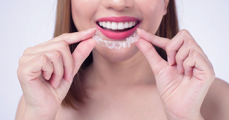Aparelho ortodôntico Invisalign: tratamento rápido e discreto