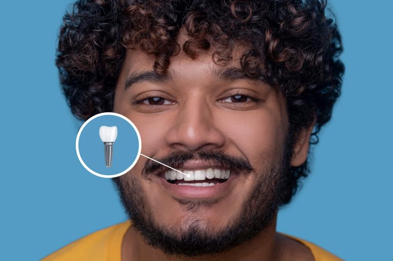 implante dentário com parafuso de titânio
